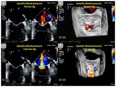 Dynamic Secondary Mitral Regurgitation: Current Evidence and Challenges for the Future